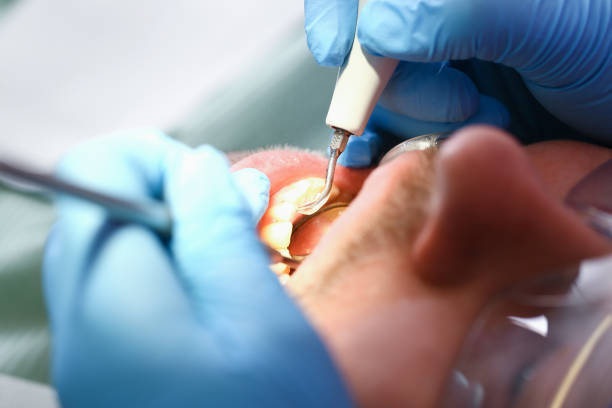 Best Broken or Chipped Tooth Repair in Cortland, NY